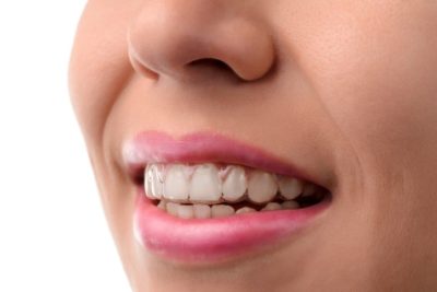 ortodoncia invisible - braquets