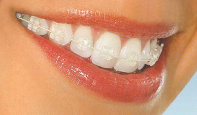 ortodoncia zafiro - braquets